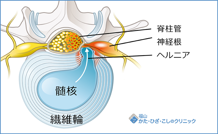脳ヘルニアの症状