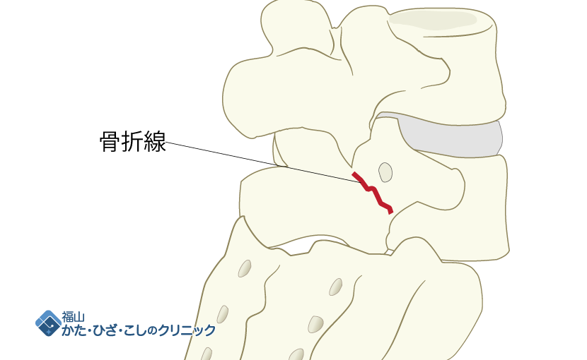 腰椎分離症挿絵_830×510